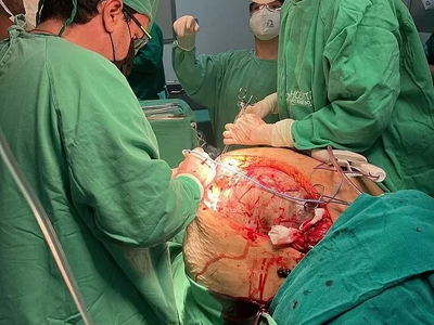 Woman With 45kg Tumor Removed [1-5 images]