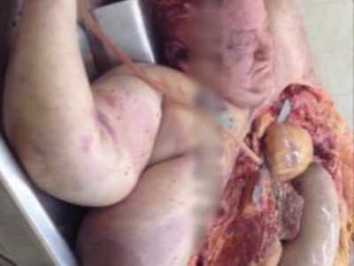fat dead woman with very big breast laying on the autopsy table