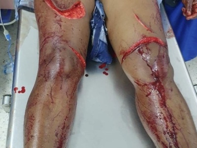 Brazilian woman victime of machete attacks 