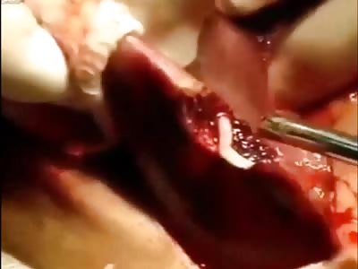 Removing worms from a liver