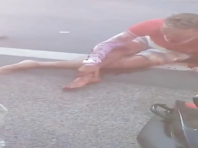 man has broken leg in the accident