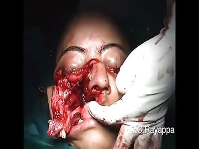 Womans face cut in half and opened up during surgery.