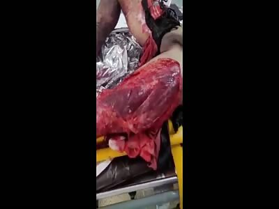 (full video) Victim of a terrible accident, had his leg skinned