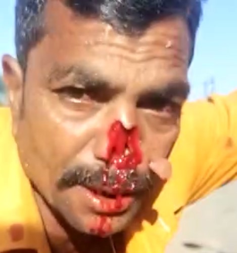 Accident victim loses nose