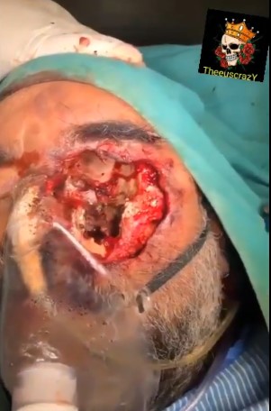 man with a huge hole in his face