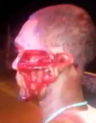 Wide Open Cut in His Face After Machete Fight