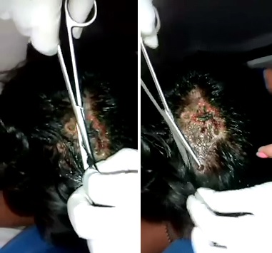 Hard to Watch Video of Crying Girl having Maggots Removed from her Scalp 