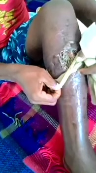 Kid reveals his Disgusting Wound with Fat maggots 