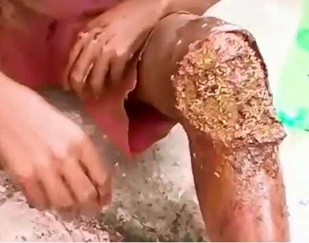 Homeless Man finally gets his Infected, Disgusting Maggot Knee Cleaned Out 