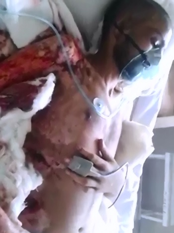 Sad Sad Video shows Young Boy with Horrible Third Degree Burns..He Died 