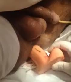 Doctor removes Dildo from Man's Asshole