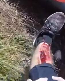 Small collision causes a big cut in his leg