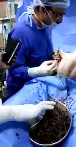 Doctors Remove 700 RUSTED Nails  from Man's Insides 