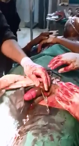 Full Surgery of Man with a Metal Ring Stuck around his Penis.....