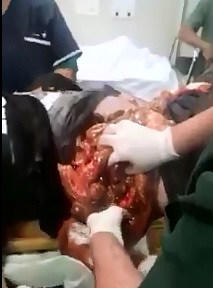 ER Visit Man enters with Guts Falling Off the Table 