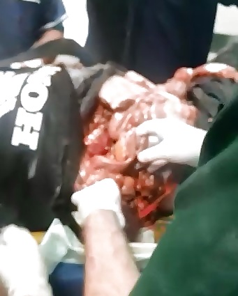 Much Better Quality Video of Man Dying on the Emergency Room Table with Guts Falling Out 