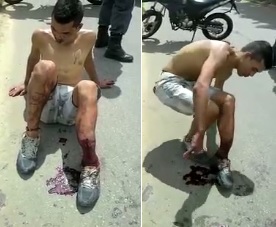Thief with broken lowerleg after being shot by police