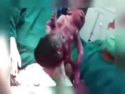 Sad Video of One Siamese Twin Dying at Birth While Doctors Laugh