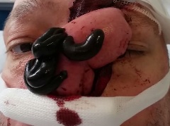 The Fu*k? Surgical Leeches after Nose Reconstruction 
