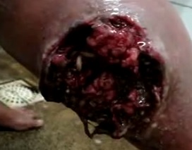 Disgusting Gross Hole in Leg with Maggots Festering