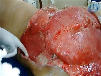 Big open wound in woman's butt