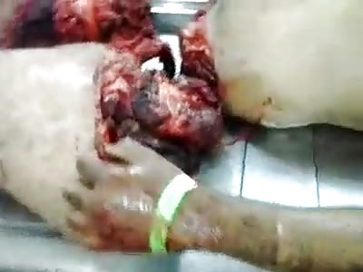 Dude Cut in Two... Ripped Apart from Bike Accident in Morgue 
