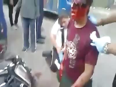 Dudes Face Literally Falling Off after Accident