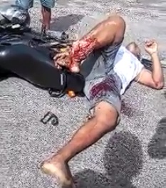 Man with lower leg ripped apart waits calmly for help