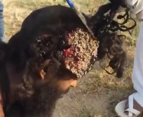 Man's Head HORRIBLY Infested with Maggots