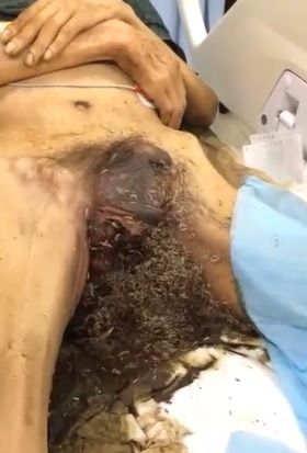 HOLY FUCK! Womans Whole Pussy Infested with Maggots
