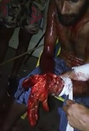 Dudes Hand is All but Gone after Machete Attack