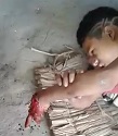 Chainsaw Accident Leaves Kid in Total Agony
