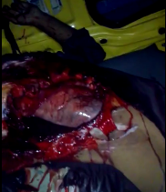 Dead man with open chest after accident