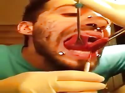 Idiot cut his tongue in half with a scalpel