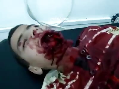 Child With Part Of His Face Shattered By A Large Caliber Bullet