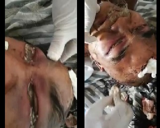 Hard To Watch: Old Man in Complete Agony With His Eyes Full Of Maggots