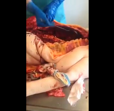 Filling an Empty Woman with Her Organs at Morgue