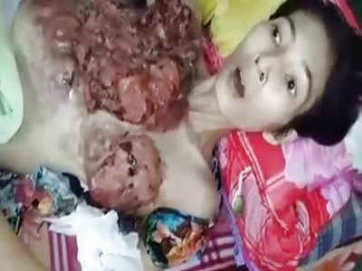 Poor Woman With a HUGE Tumor in Her Chest 