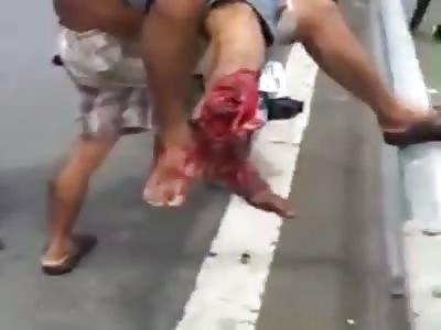 MANÂ´S LEG CRUSHED IN AN ACCIDENT