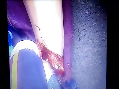 GIRL LEG FRACTURED IN ACCIDENT