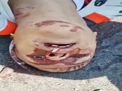 SHOCKING AFTERMATH OF MOTORCYCLE ACCIDENT 