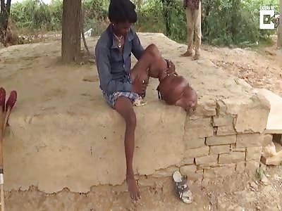 Indian Teen Has Football Sized Leg