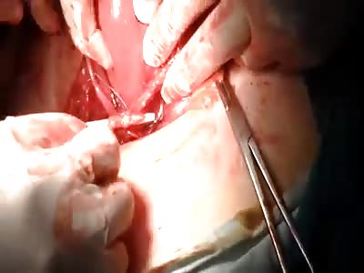 ectopic pregnancy(abdominal) removal (10 weeks)