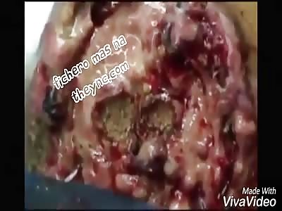 (shocking)  Advanced infection of carcer and myiasis