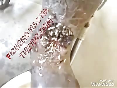 Diabetic foot with worms