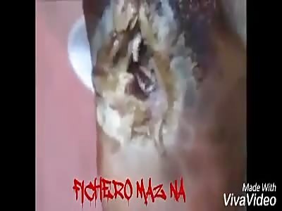 Diabetic foot infected with myiasis