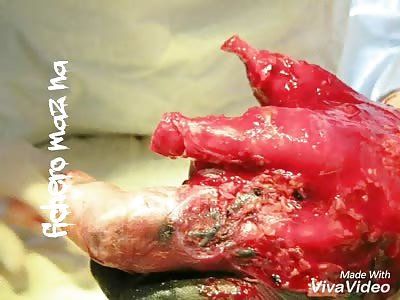 Man clings to his hand and gets his wound infected