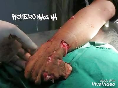 Man loses his hand in machine crusher, husband bit woman naris and a plus