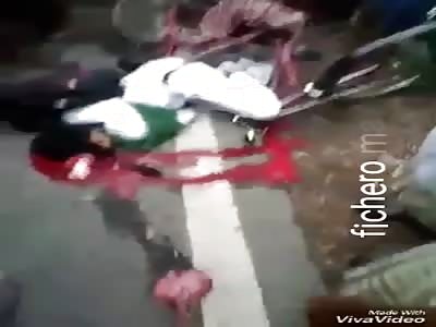 Bicycle accident with exposed brain