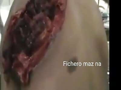 Huge back wound looks like vagina